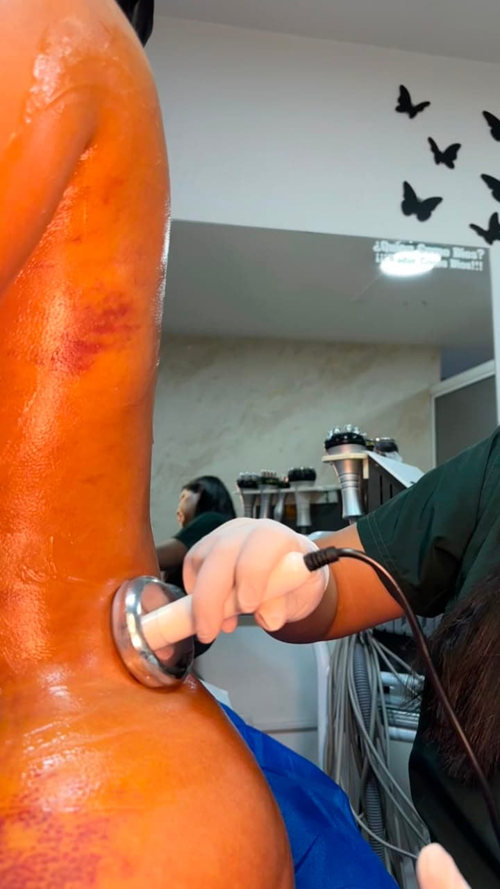 Vacumterapia sobre la pierna